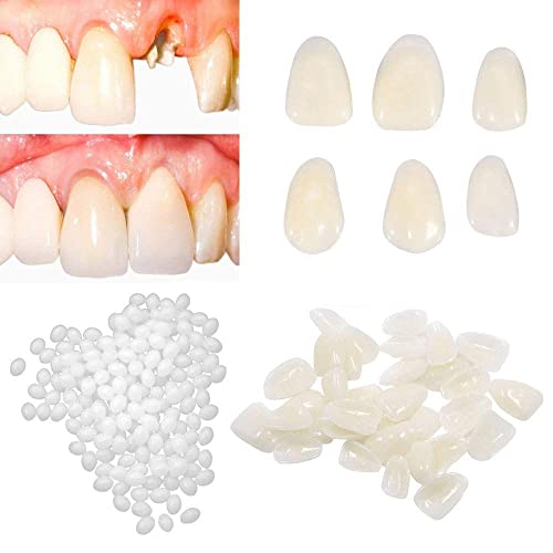 Brige Temporary Tooth Repair kit for Filling The Missing Broken Tooth and Gaps-Moldable Fake Teeth and Thermal Beads Replacement Kit